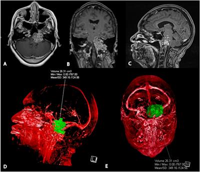 Case report: Side-firing intraoperative ultrasound guided endoscopic endonasal resection of a clival chordoma